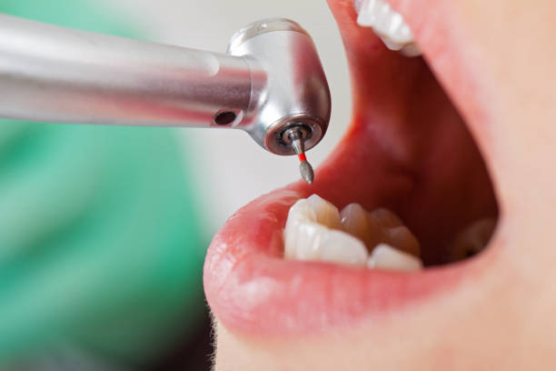 Best Dental Abscess Treatment in Woodbury, NY